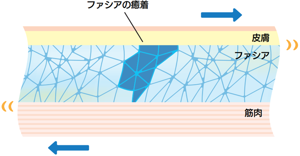 ファシアが癒着していると筋肉は動きづらくなり、そのまま動かそうとすると痛みが出ることも。